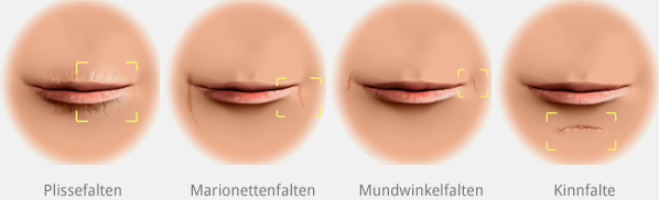 Lippenaufspritzung mit Hyaluronsäure Gel in Berlin, Lippen aufspritzen ...