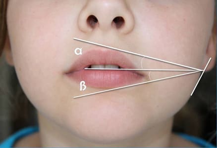 Идеальные губы с помощью шприца гиалурновой кислоты для идеальных пропорций