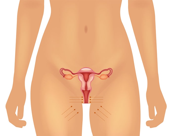 Лечение вагинизма / лечение вагинальных спазм - показывает спазм мышц во время секса