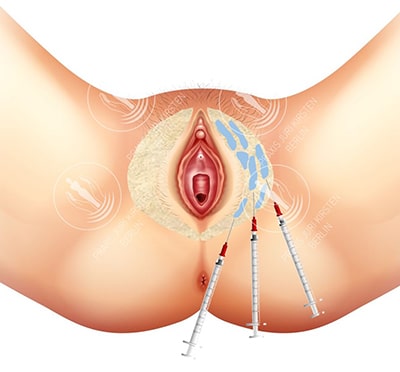 Schamlippenkorrektur der äußeren Schamlippen in Berlin. Praxis J. Kirsten