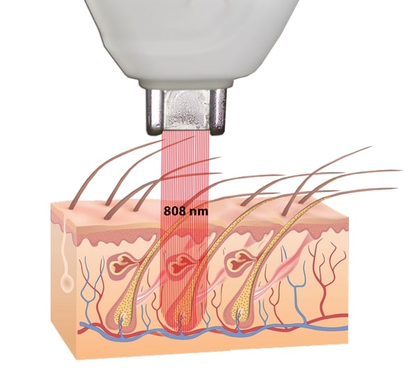 Принцип действия лазерного удаления волос диодным лазером с 808nm волнами