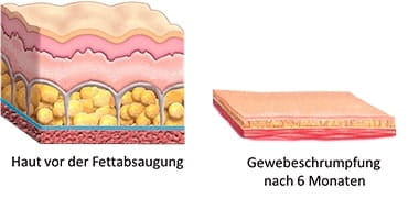 Сжатие кожных покровов после липосакции в частной клинике доктора Юрия Кирстена в Берлине, на Курфюрстендамм