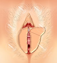 Коррекция внутренних половых губ в Берлин - Метод 2_2