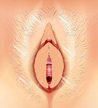 Коррекция внутренних половых губ - Техника 1_3