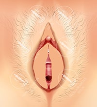 Сокращение малых половых губ - Техника 3_3