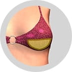 Липосакция с целью уменьшения груди у женщин в частной клинике доктора Кирстена в Берлине