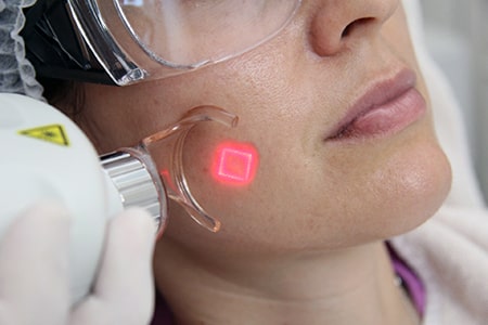 CO2 Fraxel Laser für Aknenarben Behandlung