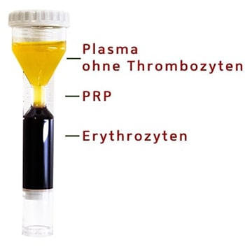 PRP Röhrchen Darstellung als Kombination für die Aknenarbenbehandlung