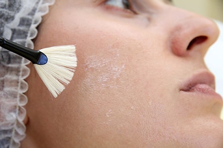 TCA Peeling und chemisches Peeling beim Aknenarben entfernen